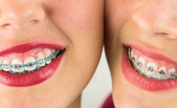 orthodontics braces-1